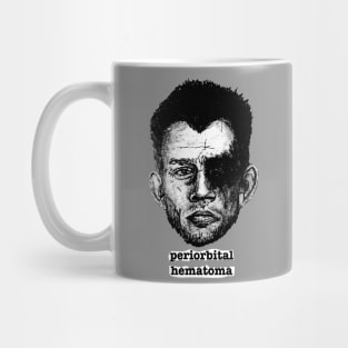 Periorbital Hematoma Mug